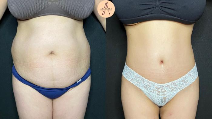 Before & After Tummy Tuck Case 68 Front View in San Antonio, Texas