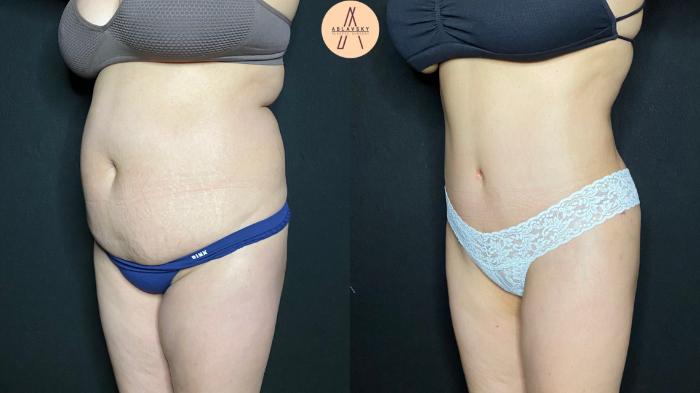 Before & After Tummy Tuck Case 68 Left Oblique View in San Antonio, Texas