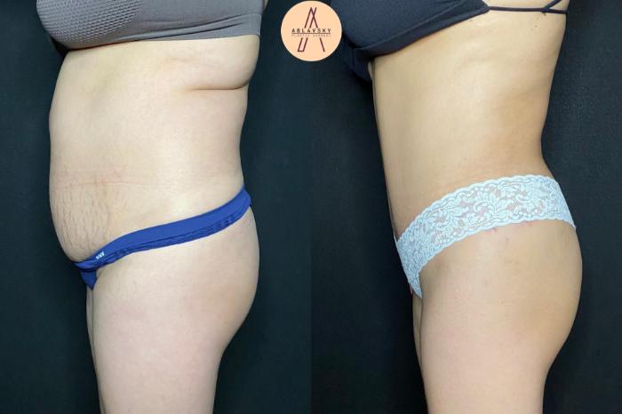 Before & After Tummy Tuck Case 68 Left Side View in San Antonio, Texas
