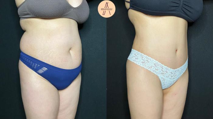 Before & After Tummy Tuck Case 68 Right Oblique View in San Antonio, Texas