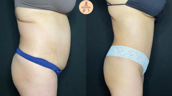 Before & After Tummy Tuck Case 68 Right Side View in San Antonio, Texas