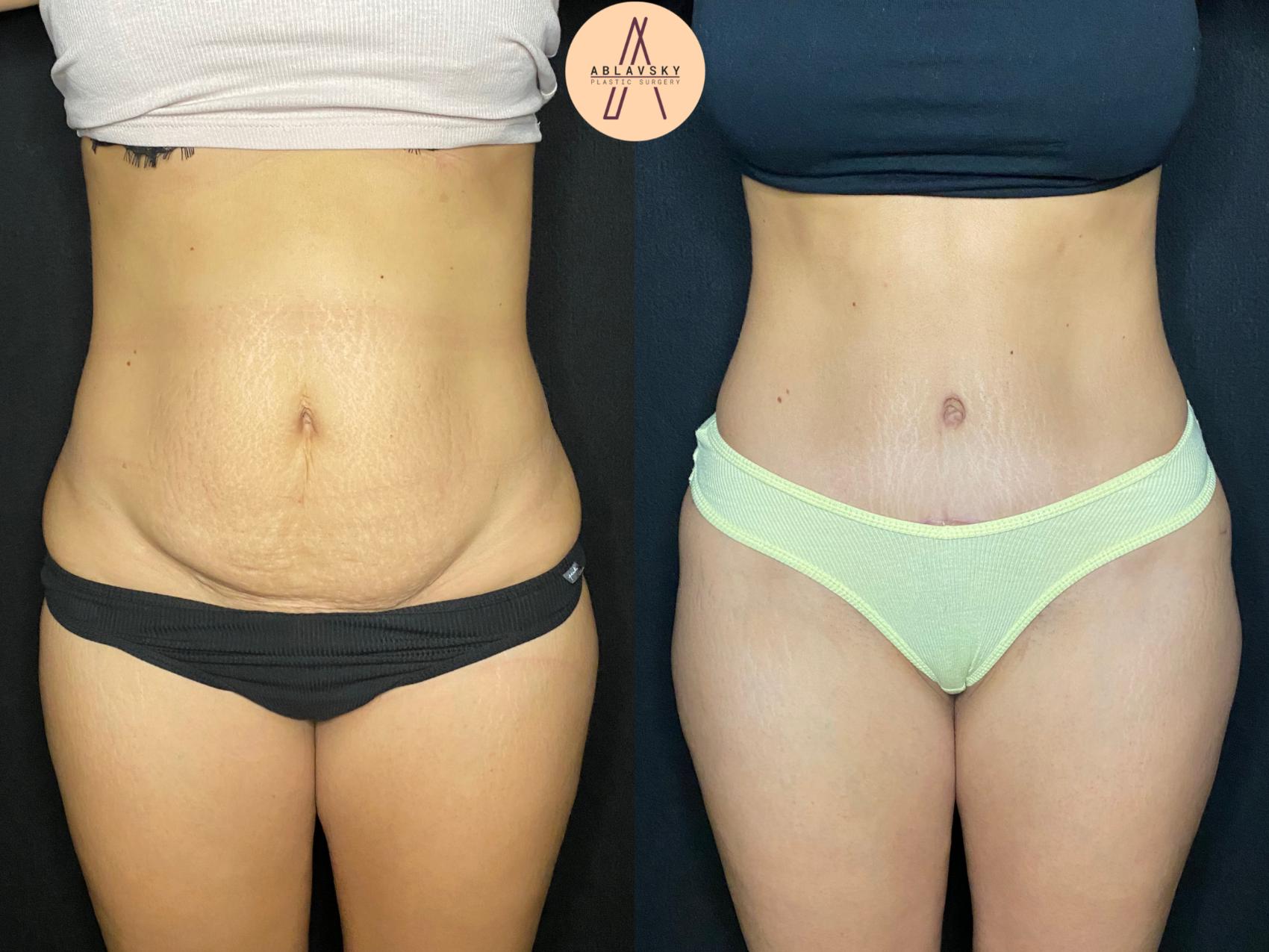 Before & After Tummy Tuck Case 75 Front View in San Antonio, Texas