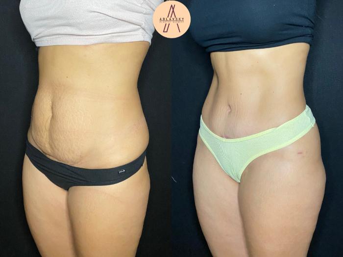 Before & After Tummy Tuck Case 75 Left Oblique View in San Antonio, Texas