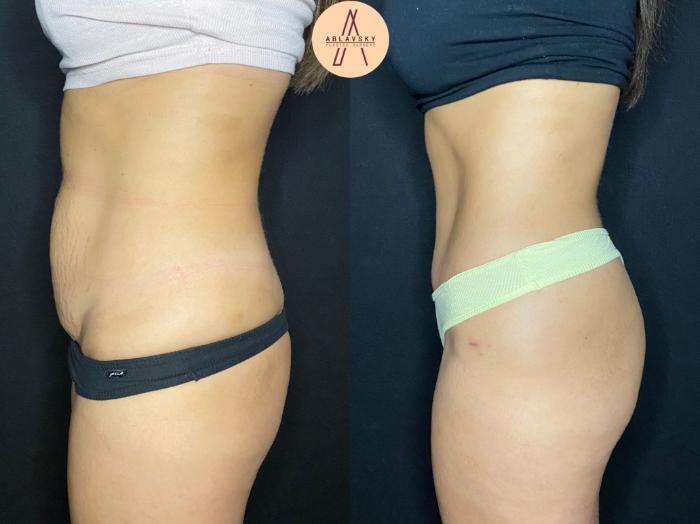 Before & After Tummy Tuck Case 75 Left Side View in San Antonio, Texas