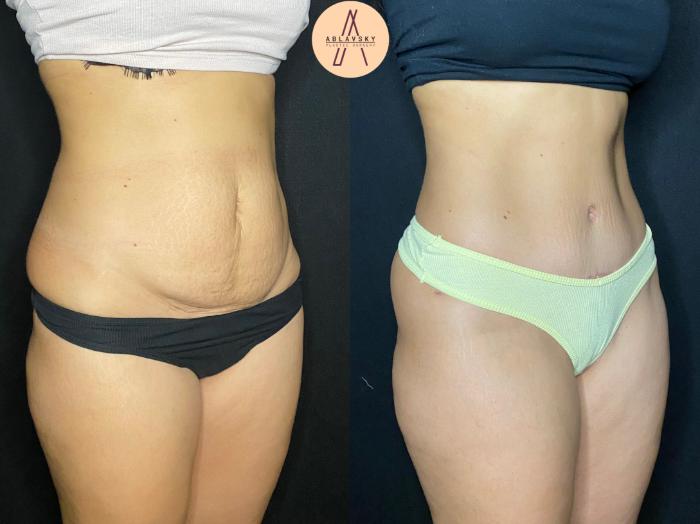 Before & After Tummy Tuck Case 75 Right Oblique View in San Antonio, Texas