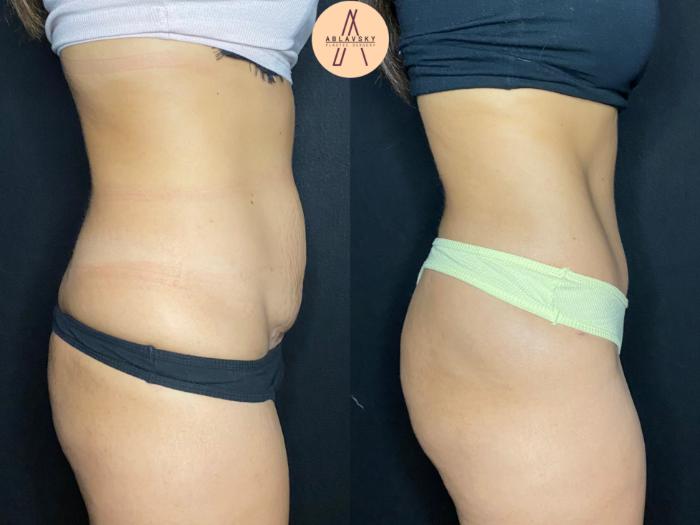 Before & After Tummy Tuck Case 75 Right Side View in San Antonio, Texas
