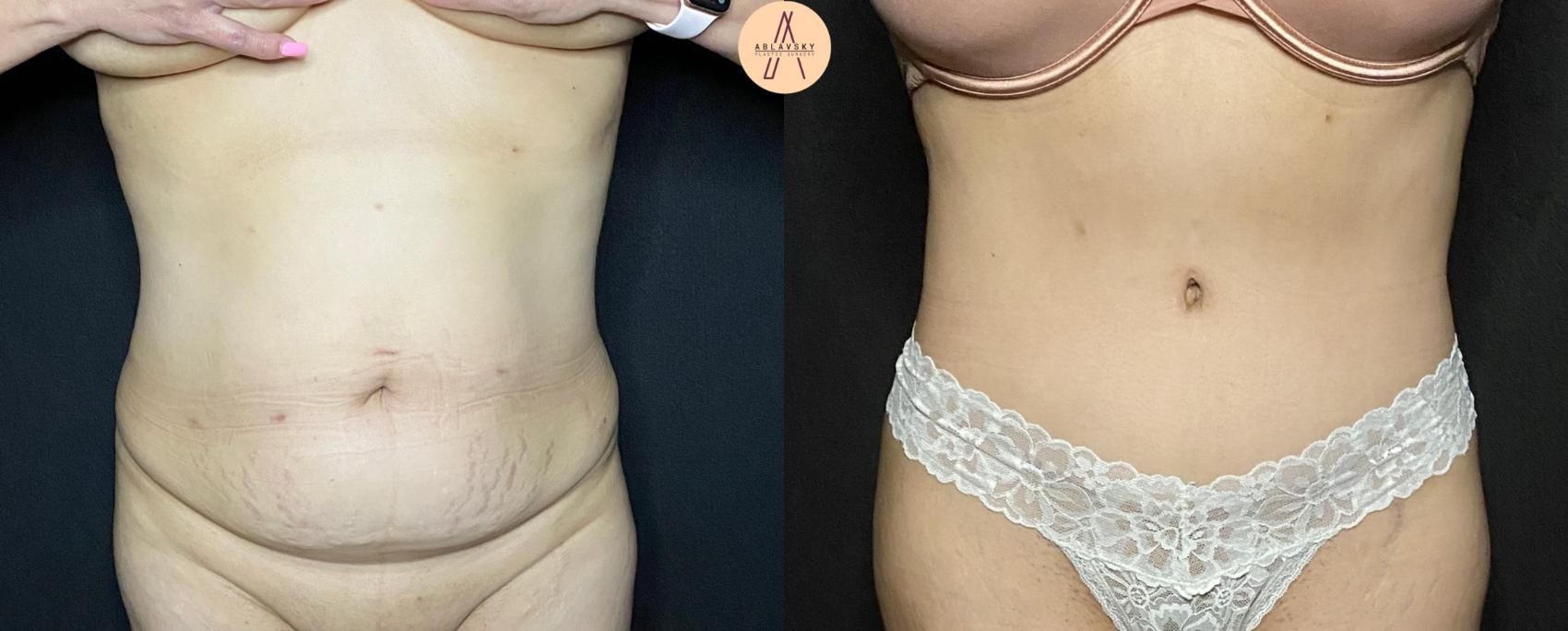 Before & After Tummy Tuck Case 81 Front View in San Antonio, Texas