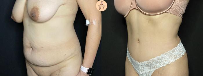 Before & After Tummy Tuck Case 81 Left Oblique View in San Antonio, Texas