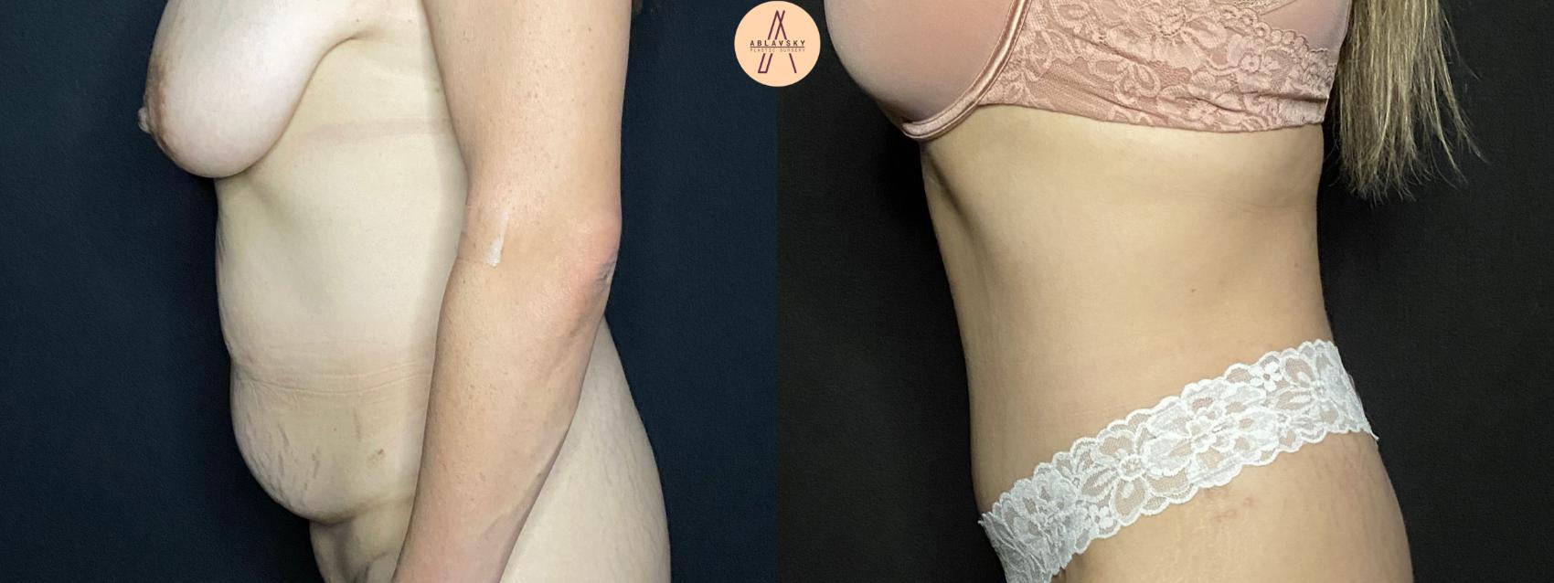 Before & After Tummy Tuck Case 81 Left Side View in San Antonio, Texas