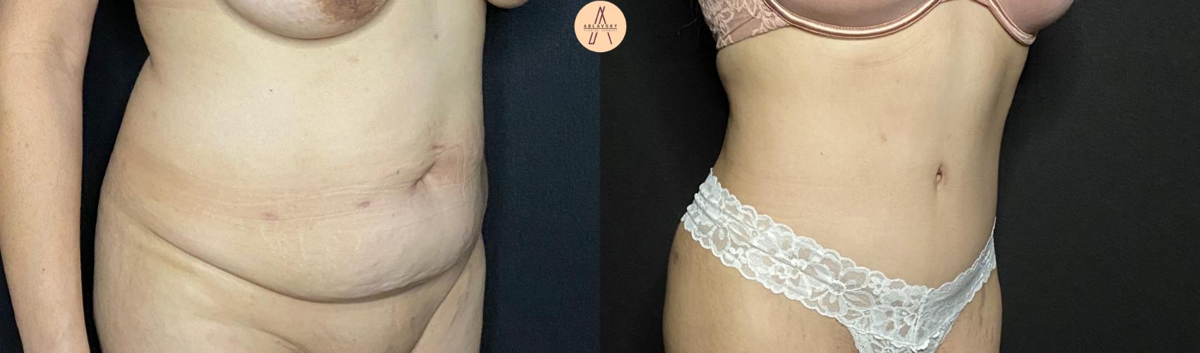 Before & After Tummy Tuck Case 81 Right Oblique View in San Antonio, Texas