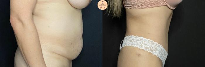 Before & After Tummy Tuck Case 81 Right Side View in San Antonio, Texas