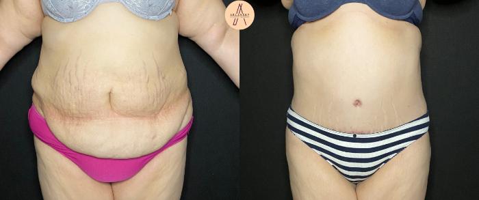 Before & After Tummy Tuck Case 83 Front View in San Antonio, Texas