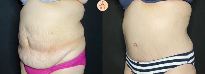 Before & After Liposuction Case 83 Left Oblique View in San Antonio, Texas