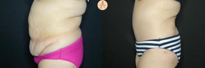 Before & After Tummy Tuck Case 83 Left Side View in San Antonio, Texas