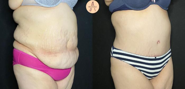 Before & After Tummy Tuck Case 83 Right Oblique View in San Antonio, Texas
