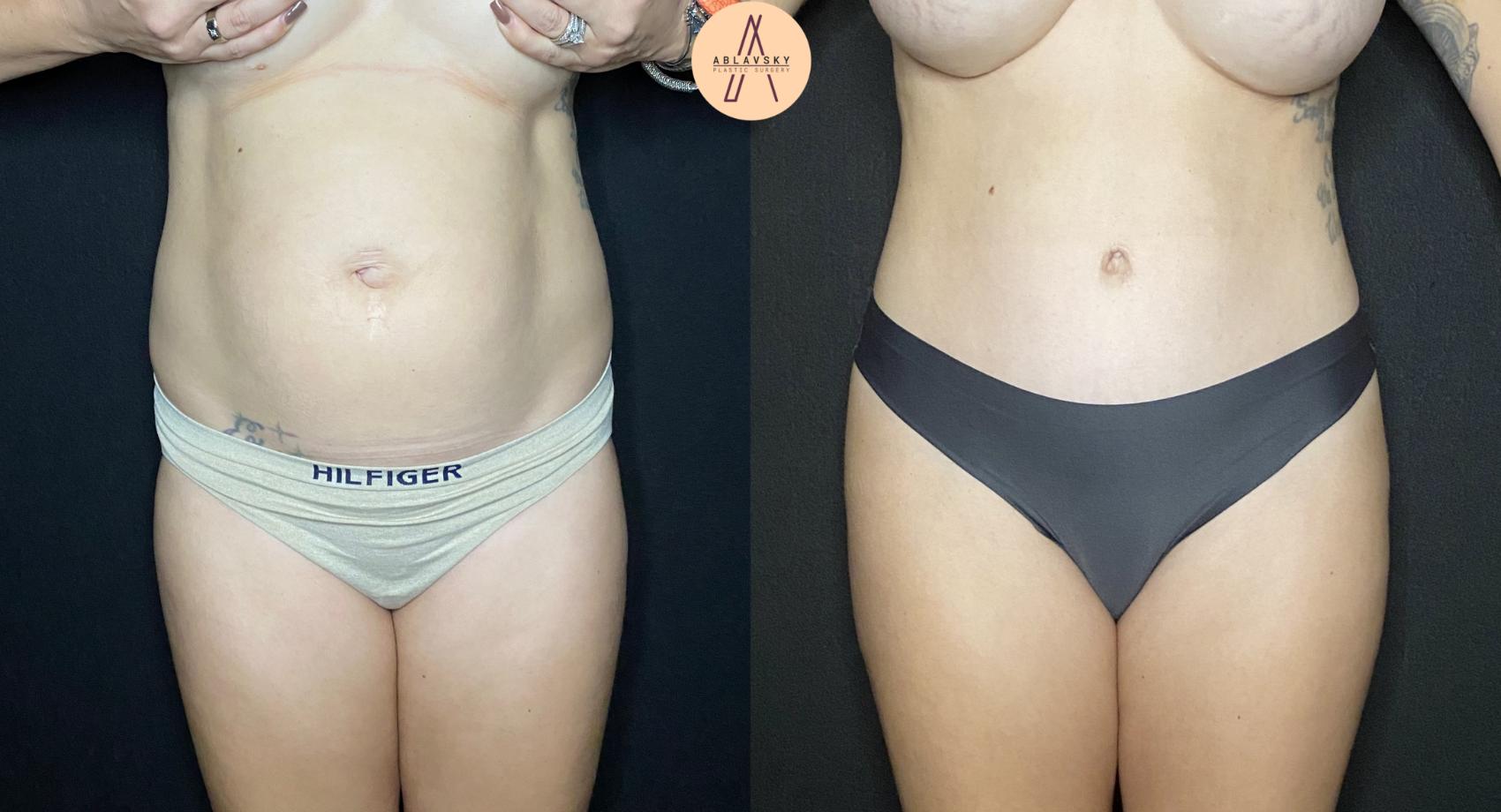 Before & After Liposuction Case 85 Front View in San Antonio, Texas