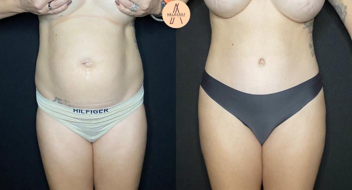 Before & After Tummy Tuck Case 85 Front View in San Antonio, Texas