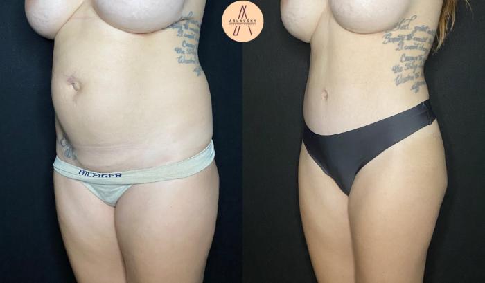 Before & After Tummy Tuck Case 85 Left Oblique View in San Antonio, Texas