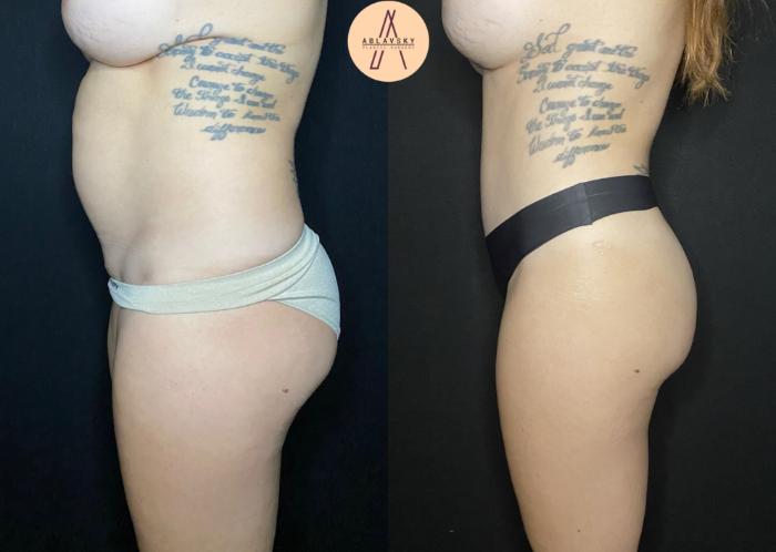 Before & After Liposuction Case 85 Left Side View in San Antonio, Texas