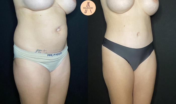 Before & After Tummy Tuck Case 85 Right Oblique View in San Antonio, Texas