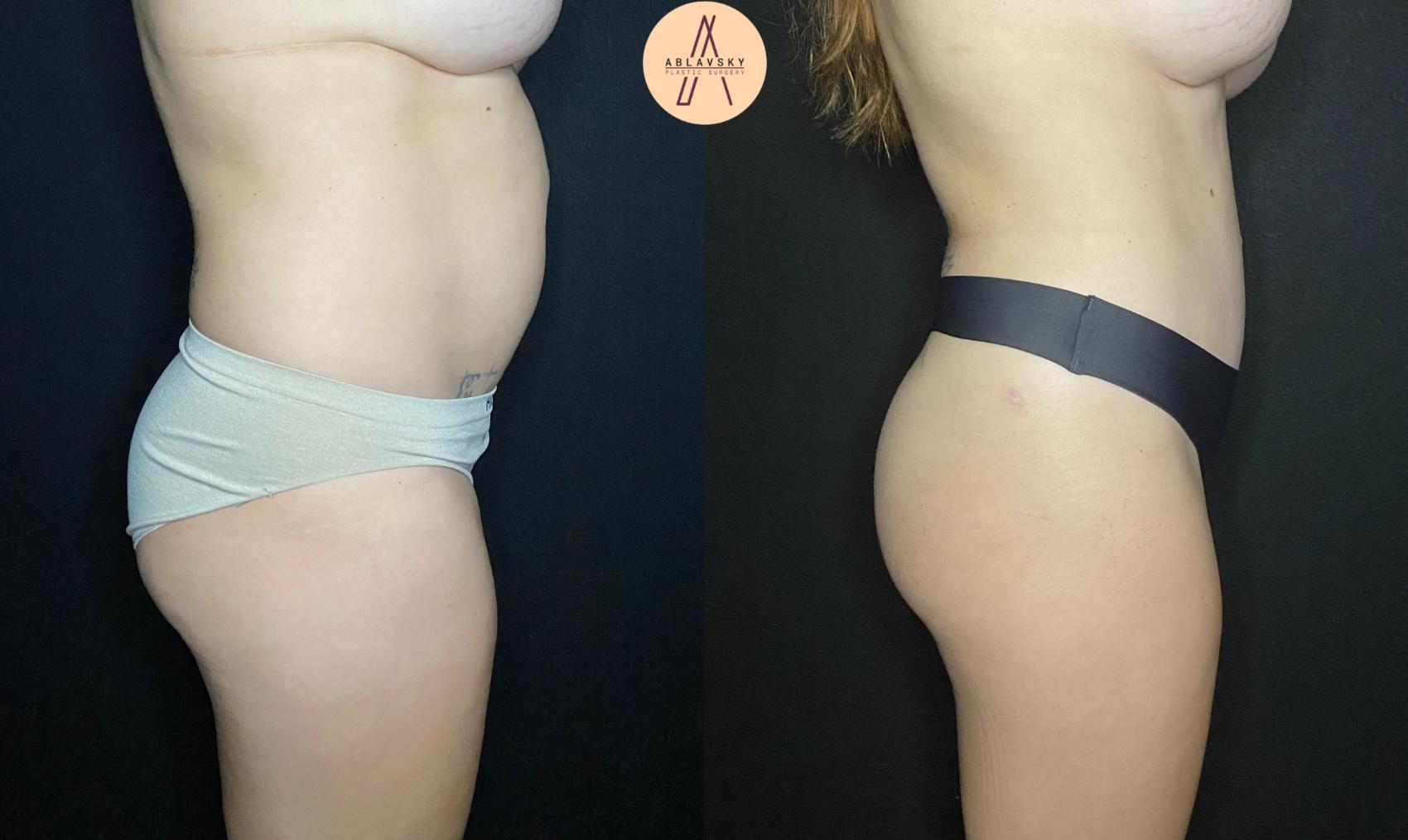 Before & After Liposuction Case 85 Right Side View in San Antonio, Texas