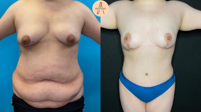 Before & After Tummy Tuck Case 86 Front View in San Antonio, Texas