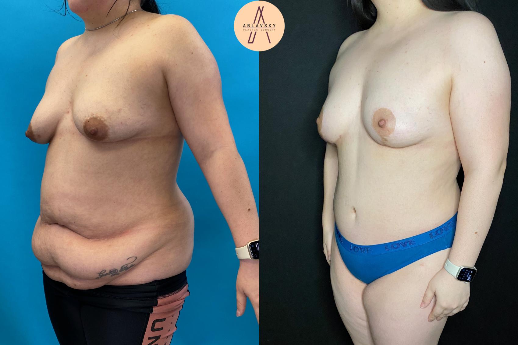 Before & After Tummy Tuck Case 86 Left Oblique View in San Antonio, Texas