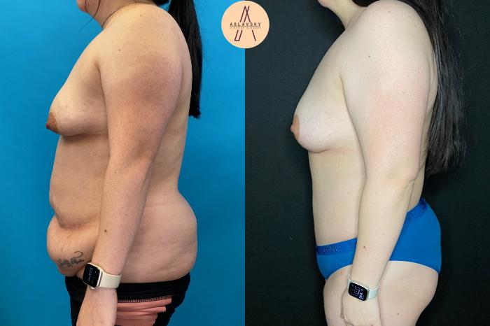 Before & After Tummy Tuck Case 86 Left Side View in San Antonio, Texas