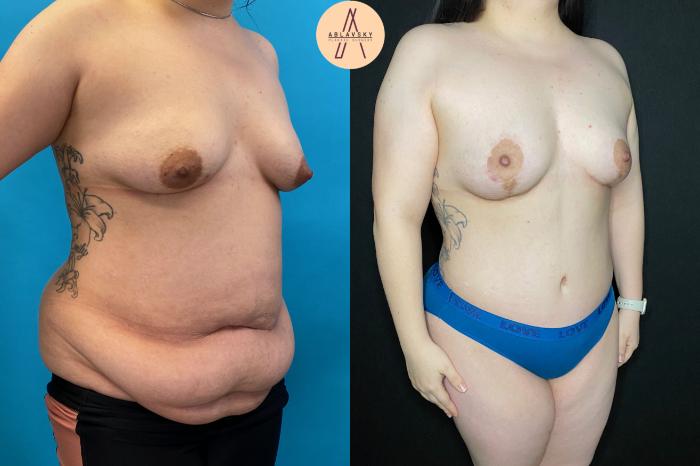 Before & After Tummy Tuck Case 86 Right Oblique View in San Antonio, Texas