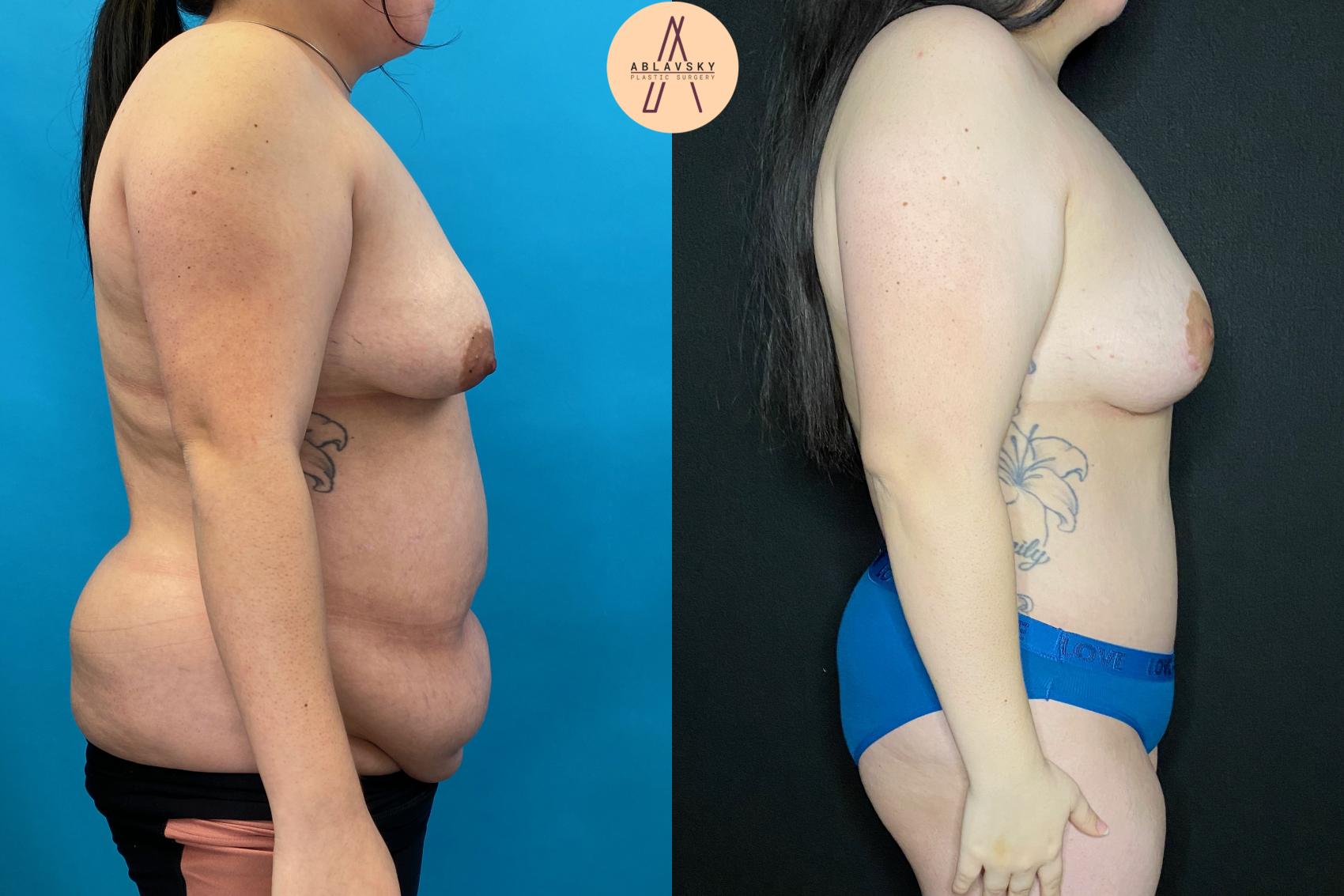 Before & After Tummy Tuck Case 86 Right Side View in San Antonio, Texas