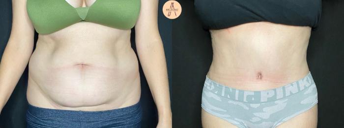 Before & After Tummy Tuck Case 92 Front View in San Antonio, Texas