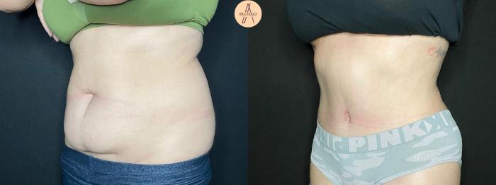 Before & After Tummy Tuck Case 92 Left Oblique View in San Antonio, Texas