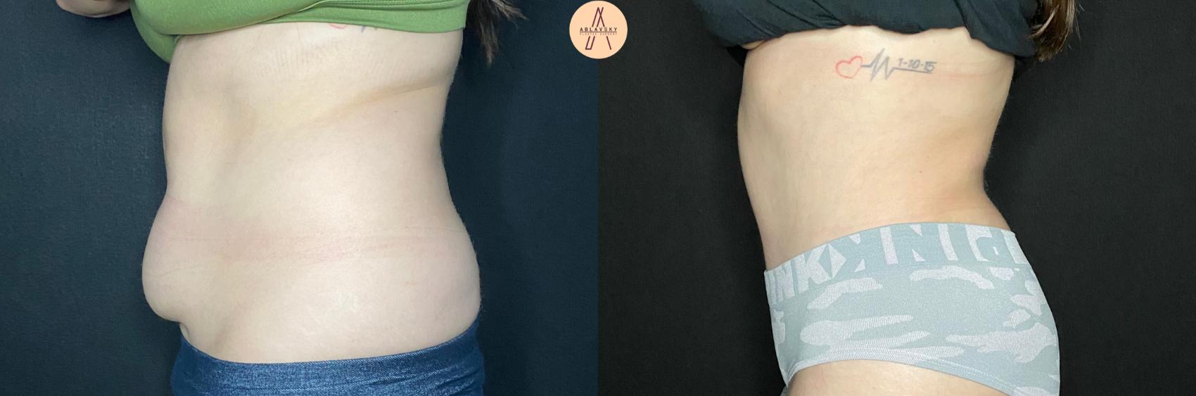 Before & After Tummy Tuck Case 92 Left Side View in San Antonio, Texas