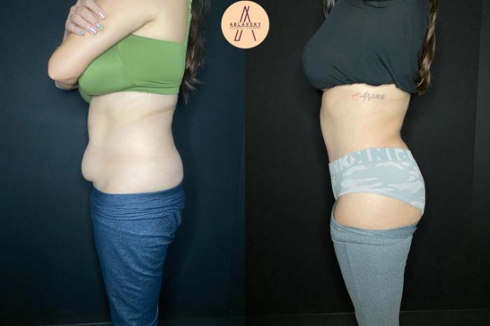 Before & After Tummy Tuck Case 92 Left Side View in San Antonio, Texas