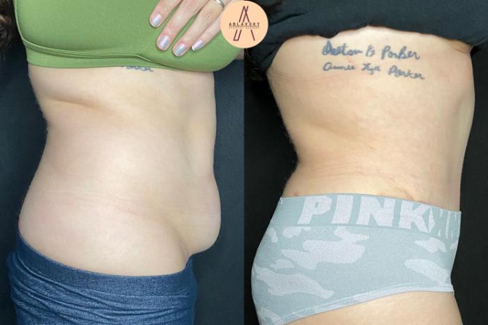 Before & After Tummy Tuck Case 92 Right Side View in San Antonio, Texas