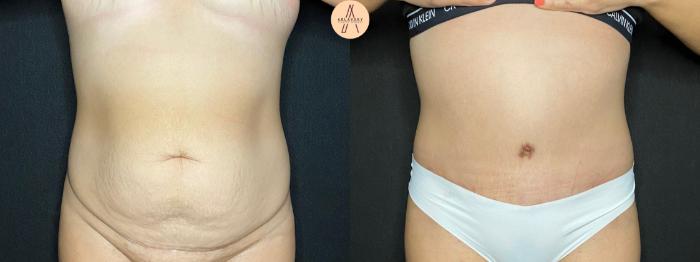Before & After Tummy Tuck Case 93 Front View in San Antonio, Texas