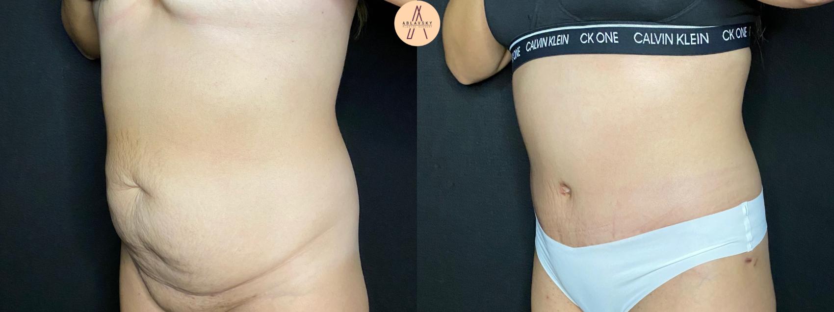 Before & After Tummy Tuck Case 93 Left Oblique View in San Antonio, Texas