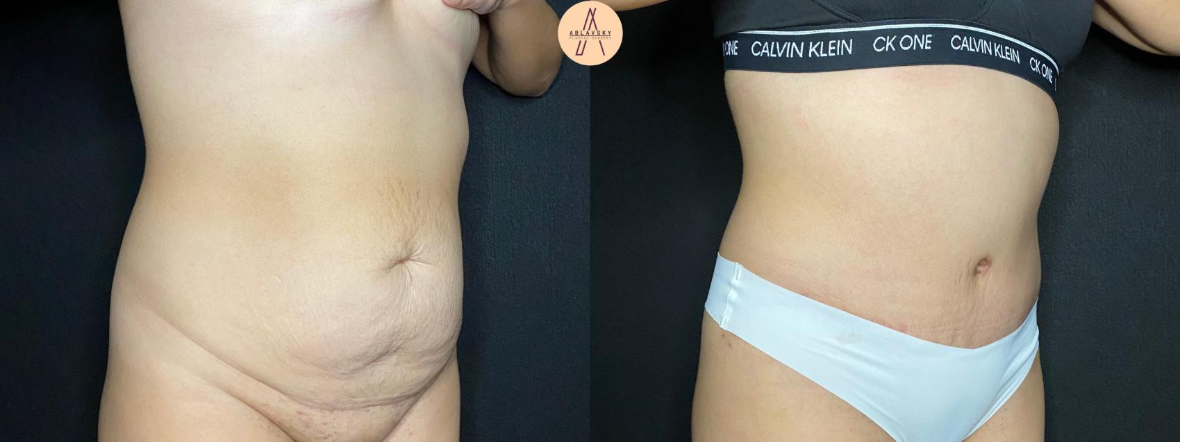 Before & After Tummy Tuck Case 93 Right Oblique View in San Antonio, Texas