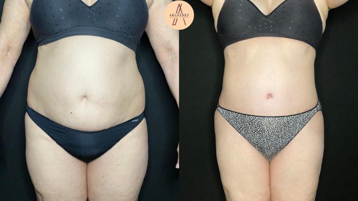 Before & After Tummy Tuck Case 95 Front View in San Antonio, Texas