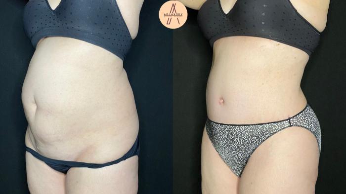 Before & After Tummy Tuck Case 95 Left Oblique View in San Antonio, Texas