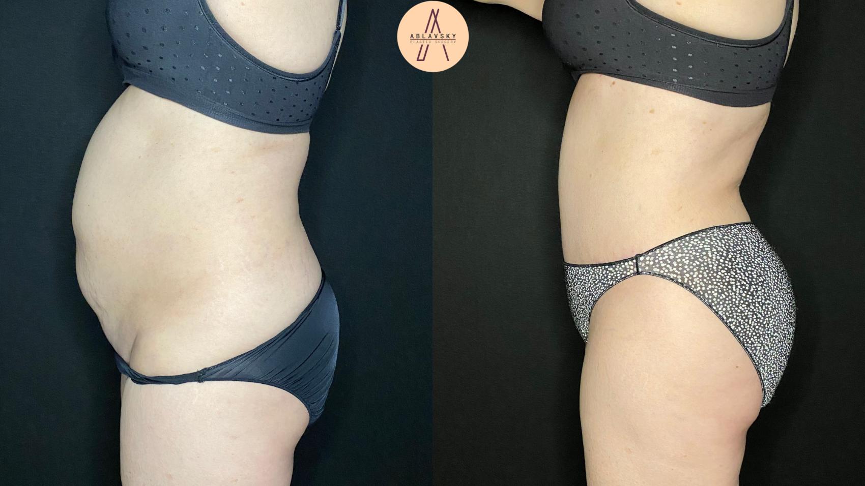Before & After Tummy Tuck Case 95 Left Side View in San Antonio, Texas