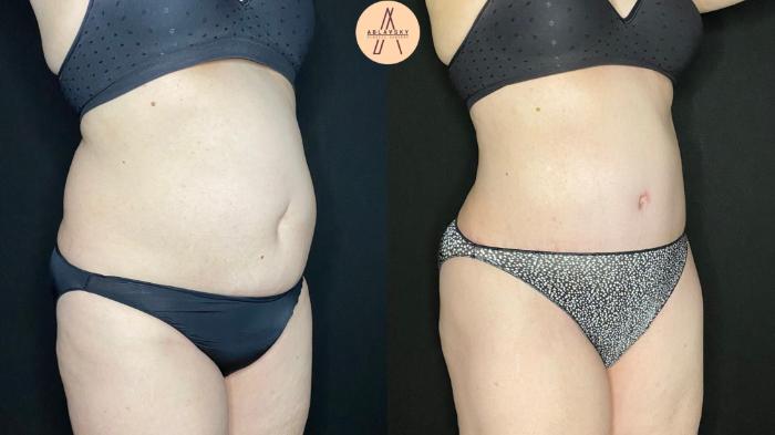 Before & After Tummy Tuck Case 95 Right Oblique View in San Antonio, Texas