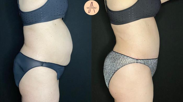 Before & After Tummy Tuck Case 95 Right Side View in San Antonio, Texas