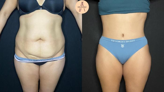 Before & After Tummy Tuck Case 97 Front View in San Antonio, Texas