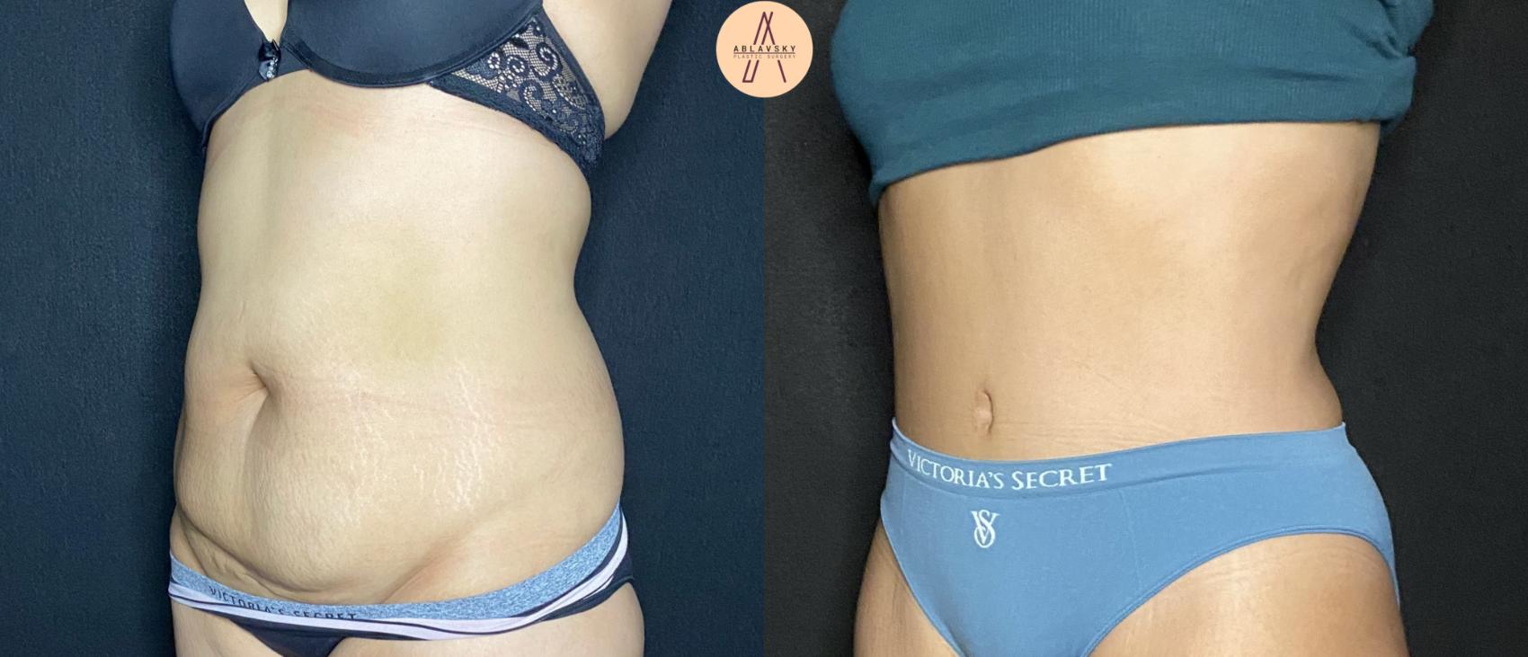 Before & After Tummy Tuck Case 97 Left Oblique View in San Antonio, Texas