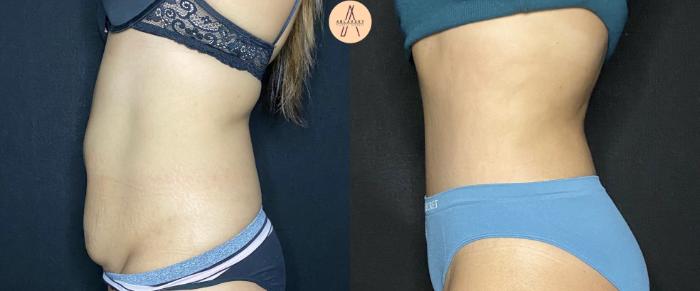 Before & After Tummy Tuck Case 97 Left Side View in San Antonio, Texas