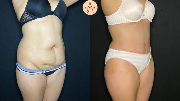 Before & After Tummy Tuck Case 97 Right Oblique View in San Antonio, Texas