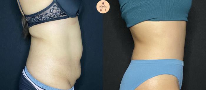 Before & After Tummy Tuck Case 97 Right Side View in San Antonio, Texas