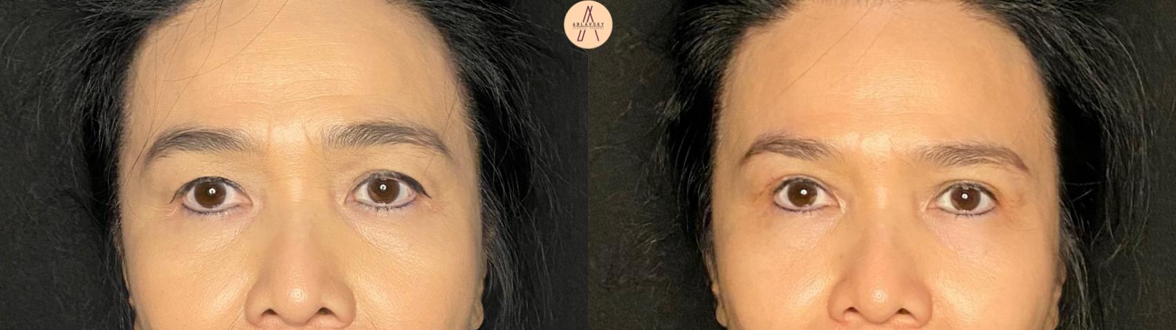 Before & After Upper Blepharoplasty Case 132 Front View in San Antonio, Texas