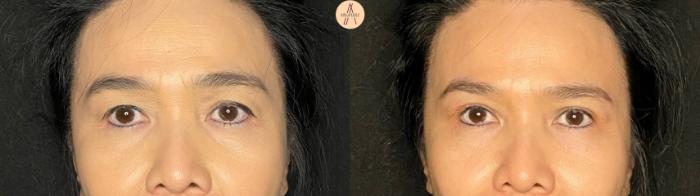 Before & After Upper Blepharoplasty Case 132 Front View in San Antonio, Texas